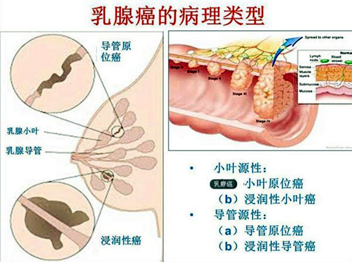 乳腺癌6.jpg